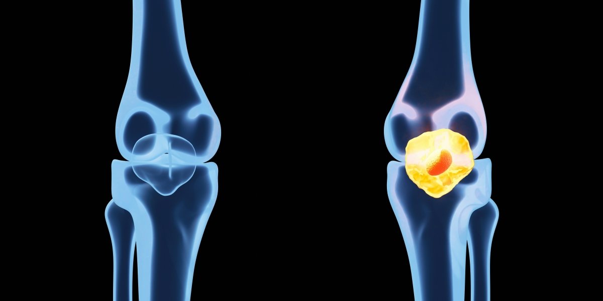 Non-Surgical Knee Pain Care at Hollywood Laser Pain Center